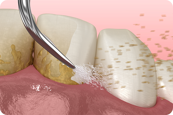 むし歯や歯周病の予防歯科
